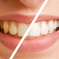 teeth whitening difference 1